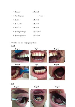 • Palatum : Normal
• Oropharyngeal : Normal
• Saliva : Normal
• Kel.Limfe : Normal
• Frenulum : Normal
• Habit, parafungsi : Tidak Ada
• Kontak prematur : Tidak ada
Foto intra oral saat kunjungan pertama
Facial
Regio a Regio b Regio c
Regio d Regio e Regio f
Oral
Regio a Regio b Regio c
Regio d Regio e Regio f
4
 
