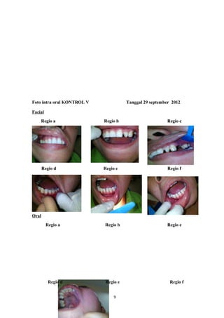 Foto intra oral KONTROL V Tanggal 29 september 2012
Facial
Regio a Regio b Regio c
Regio d Regio e Regio f
Oral
Regio a Regio b Regio c
Regio d Regio e Regio f
9
 