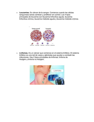 • Leucemias. Es cáncer de la sangre. Comienza cuando las células
sanguíneas sanas cambian y proliferan sin control. Los 4 tipos
principales de leucemia son leucemia linfocítica aguda, leucemia
linfocítica crónica, leucemia mieloide aguda y leucemia mieloide crónica.
• Linfomas. Es un cáncer que comienza en el sistema linfático. El sistema
linfático es una red de vasos y glándulas que ayudan a combatir las
infecciones. Hay 2 tipos principales de linfomas: linfoma de
Hodgkin y linfoma no Hodgkin.
 