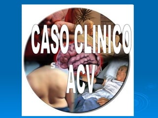 CASO CLINICO ACV 