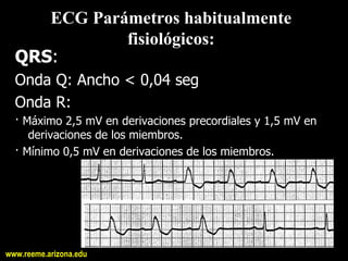 ECG Parámetros habitualmente 
             fisiológicos: 
  QRS: 
  Onda Q: Ancho < 0,04 seg 
  Onda R: 
  · Máximo 2,5 mV en derivaciones precordiales y 1,5 mV en 
     derivaciones de los miembros. 
  · Mínimo 0,5 mV en derivaciones de los miembros.




www.reeme.arizona.edu
 