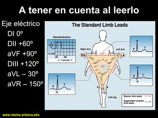A tener en cuenta al leerlo 
Eje eléctrico 
  DI 0º 
  DII +60º 
  aVF +90º 
  DIII +120º 
  aVL – 30º 
  aVR – 150º



www.reeme.arizona.edu
 