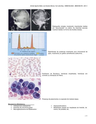 Arlindo Ugulino Netto; Luiz Gustavo Barros; Yuri Leite Eloy – HEMATOLOGIA – MEDICINA P8 – 2011.1
238
Radiografia simples mostrando importantes les…es
em “saca-bocado” no cr‹nio. As manchas escuras
mostram les…es na forma de eros…es €sseas.
Eletroforese de prote†nas mostrando pico monoclonal de
IgGκ, mostrando um gr„fico semelhante ‘ albumina.
Fen’meno de Rouleaux: hem„cias empilhadas, hem„cias em
corrente ou hem„cias em fileira.
Presen•a de plasm€citos no aspirado de medula €ssea.
DIAGN•STICO DIFERENCIAL
 Osteoporose (osteopenia)
 Anemias de uma forma geral
 Macroglobulinemia de Waldenstron
 Hiperparatiroidismo
 Met„stases €sseas de neoplasias de tire€ide, de
mama, de pr€stata, etc.
 