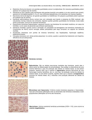 Arlindo Ugulino Netto; Luiz Gustavo Barros; Yuri Leite Eloy – HEMATOLOGIA – MEDICINA P8 – 2011.1
119
 Eliptócitos (forma de charuto): em grandes quantidades comum na eliptocitose. Em menores quantidades podem
aparecer em qualquer tipo de anemia.
 Hemácias em alvo (células cujas membranas são grandes havendo uma palidez e um alvo central mais corado):
aparece em hemoglobinopatias C, E ou S, nas síndromes talassêmicas e em pacientes com doença hepática.
 Dacriócitos (forma de lágrima): em grande quantidade na mielofibrose. Em pequena quantidade podem aparecer
em qualquer tipo de anemia.
 Hemácias policromáticas (forma normal mas com coloração azul devido a presença de RNA residual): são
reticulócitos, formas imaturas dos eritrócitos. Aparece quando grandes quantidades de hemácias novas estão
sendo produzidas. Comuns em anemias hemolíticas.
 Esquizócitos (hemácias fragmentadas): aparecem quando nas hemácias há uma lesão mecânica, em casos de
hemólise, ou em casos de pacientes que sofreram queimaduras.
 Hemácias mordidas: quando ocorre a formação um precipitado de hemoglobina nas hemácias (chamados de
Corpúsculos de Heinz) ocorre remoção destes precipitados pelo baço formando um aspecto de hemácia
mordida.
 Acantócitos (hemácias com pontas de diversos tamanhos): nas hepatopatias, hipofunção esplênica,
esplenectomizados.
 Crenadas (hemácias com várias pontas pequenas): na uremia, quando o paciente faz tratamento com heparina,
deficiência de piruvatoquinase.
Hemácias normais.
Reticulócitos. São as células precursoras imediatas das hemácias, sendo elas o
último ponto da diferenciação do pró-eritroblasto. Sua análise na decorrência de uma
anemia determina o grau de produção das células na medula óssea: se ela estiver
presente, significa dizer que a anemia é regenerativa (anemia decorrente de uma
hemorragia; anemia hemolítica, etc.) e, com isso, há produção normal de células na
medula óssea; se ela estiver ausente, significa dizer que a anemia é arregenerativa
(tumores de medula óssea, etc.), indicando uma produção deficiente de células na
medula.
Microcitose com hipocromia. A lâmina mostra hemácias pequenas e hipocoradas,
mas sem anisocitose (alterações entre as dimensões das hemácias analisadas) e sem
poiquilocitose (alterações na forma das hemácias).
Macrocitose. Lâmina mostrando hemácias aumentadas (VCM > 110), como ocorre na
anemia megalobástica.
 