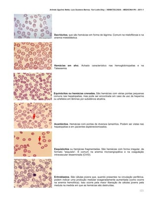 Arlindo Ugulino Netto; Luiz Gustavo Barros; Yuri Leite Eloy – HEMATOLOGIA – MEDICINA P8 – 2011.1
121
Dacriócitos, que s‚o hem„cias em forma de l„grima. Comum na mielofibrose e na
anemia mielobl„stica.
Hemácias em alvo. Achado caracter†stico nas hemoglobinopatias e na
Talassemia.
Equinócitos ou hemácias crenadas. S‚o hem„cias com v„rias pontas pequenas
comuns nas hepatopatias, mas pode ser encontrada em caso de uso de heparina
ou artefatos em l‹minas por subst‹ncia alcalina.
Acantócitos. Hem„cias com pontas de diversos tamanhos. Podem ser vistas nas
hepatopatias e em pacientes esplenectomizados.
Esquizócitos ou hem„cias fragmentadas. S‚o hem„cias com forma irregular, de
formato “esquisito”. ‡ comum na anemia microangiop„tica e na coagula•‚o
intravascular disseminada (CIVD).
Eritroblastos. S‚o cƒlulas jovens que, quando presentes na circula•‚o perifƒrica,
podem indicar uma produ•‚o medular exageradamente aumentada (como ocorre
na anemia hemol†tica). Isso ocorre pela maior libera•‚o de cƒlulas jovens pela
medula na medida em que as hem„cias s‚o destru†das.
 