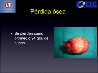 Pérdida ósea


• Se pierden como
  promedio 94 grs. de
  hueso.
 