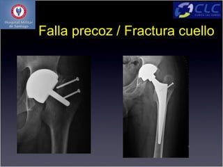 Falla precoz / Fractura cuello
 