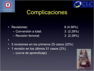 Complicaciones

• Revisiones:                           6 (4.56%)
   – Conversión a total:                3 (2.28%)
   – Revisión femoral:                  3 (2.28%)
•
• 5 revisiones en los primeros 25 casos (20%)
• 1 revisión en los últimos 51 casos (2%)
   – (curva de aprendizaje)
 