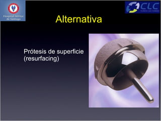 Alternativa


Prótesis de superficie
(resurfacing)
 