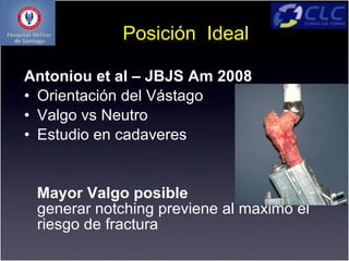Posición Ideal

Antoniou et al – JBJS Am 2008
• Orientación del Vástago
• Valgo vs Neutro
• Estudio en cadaveres


 Mayor Valgo posible                    sin
 generar notching previene al máximo el
 riesgo de fractura
 