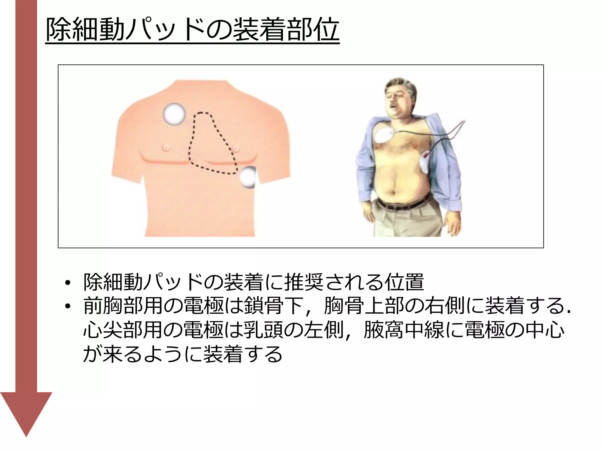 •  除細動パッドの装着に推奨される位置
•  前胸部⽤の電極は鎖⾻下，胸⾻上部の右側に装着する．
⼼尖部⽤の電極は乳頭の左側，腋窩中線に電極の中⼼
が来るように装着する
除細動パッドの装着部位
 