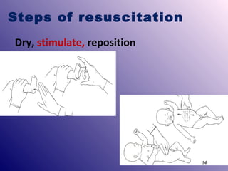 Steps of resuscitation
Dry, stimulate, reposition

14

 