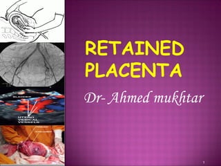Dr- Ahmed mukhtar
RETAINED
PLACENTA
1
 