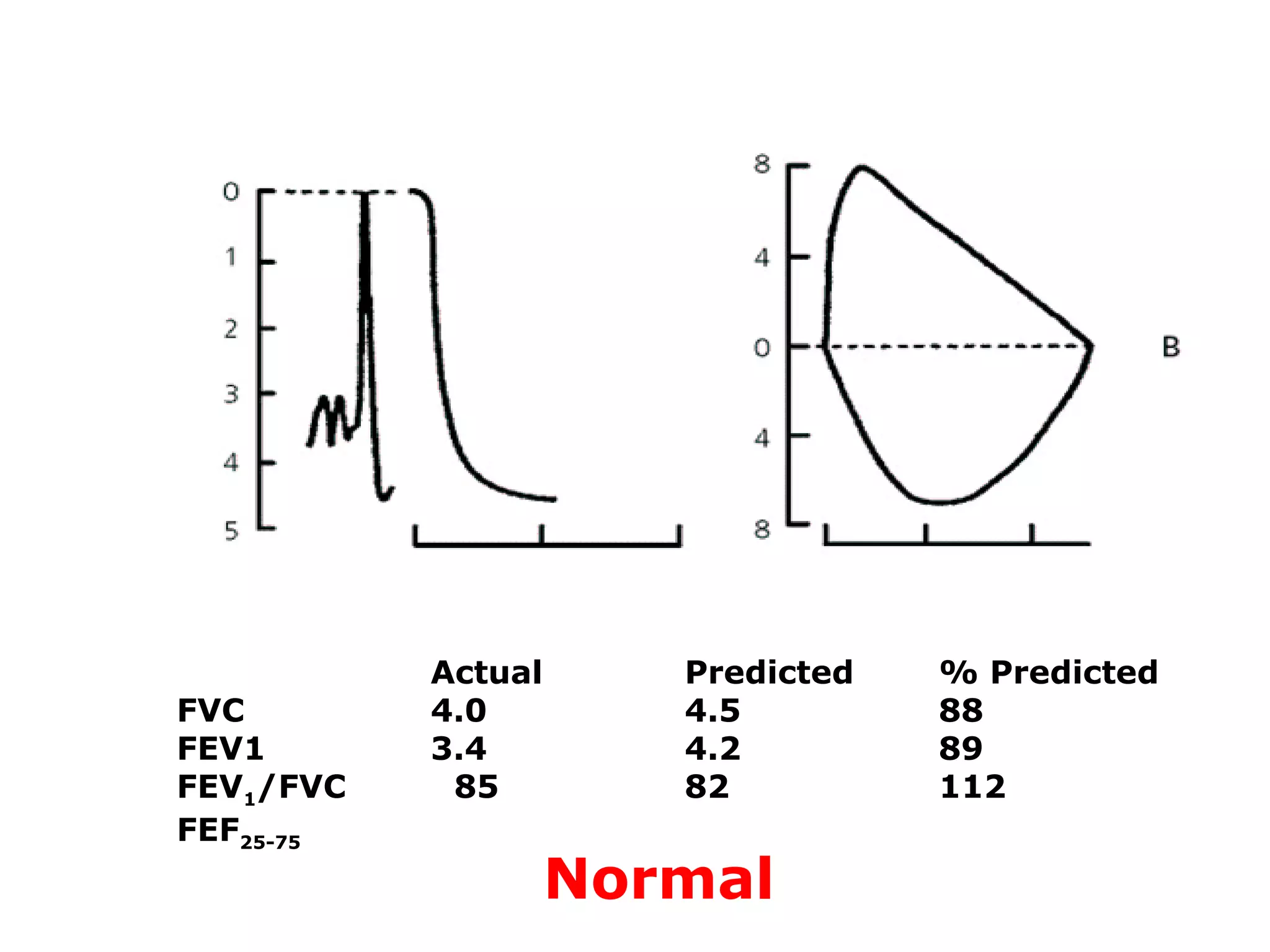 Actual Predicted % Predicted 
FVC 4.0 4.5 88 
FEV1 3.4 4.2 89 
FEV1/FVC 85 82 112 
FEF25-75 
Normal 
 