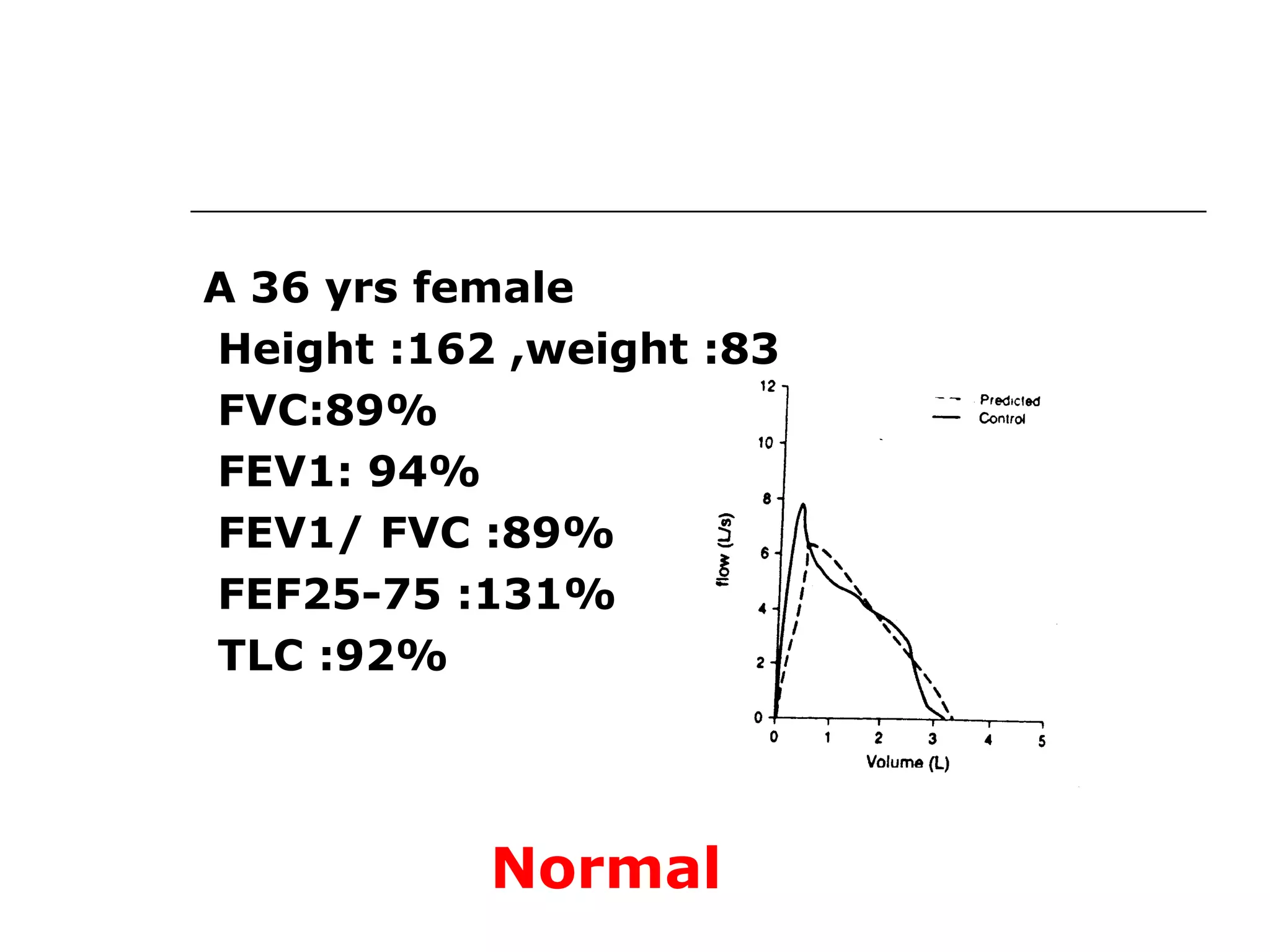 A 36 yrs female 
Height :162 ,weight :83 
FVC:89% 
FEV1: 94% 
FEV1/ FVC :89% 
FEF25-75 :131% 
TLC :92% 
Normal 
 