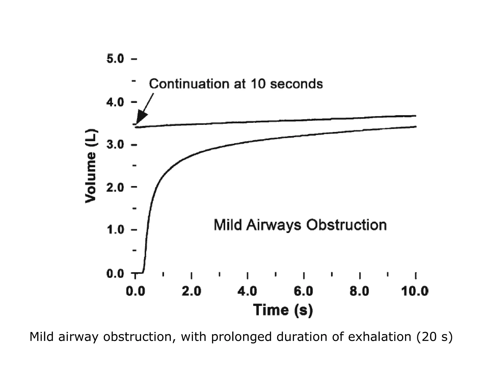 Mild airway obstruction, with prolonged duration of exhalation (20 s) 
 