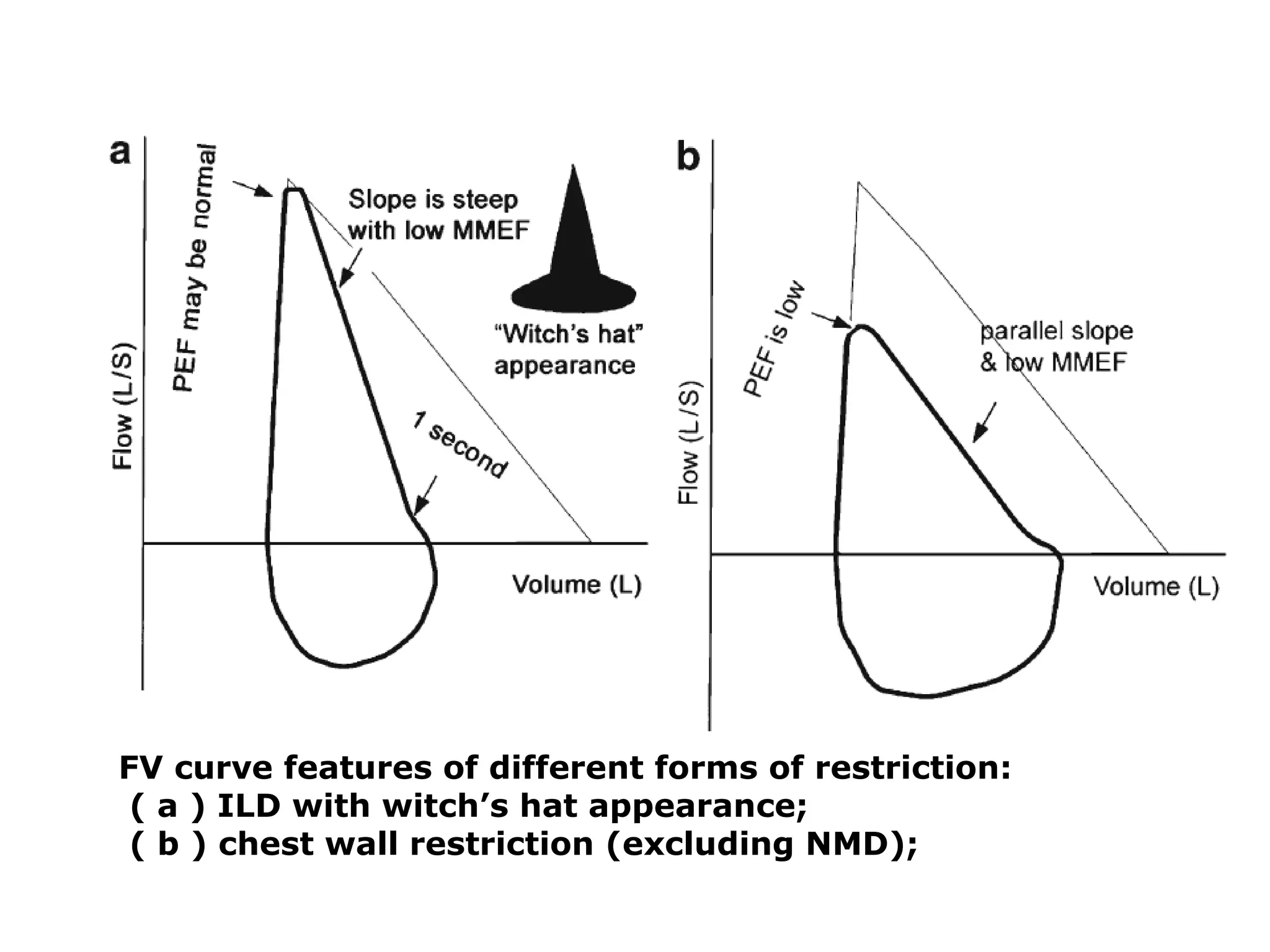 FV curve features of different forms of restriction: 
( a ) ILD with witch’s hat appearance; 
( b ) chest wall restriction (excluding NMD); 
 