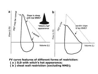 FV curve features of different forms of restriction: 
( a ) ILD with witch’s hat appearance; 
( b ) chest wall restriction (excluding NMD); 
 