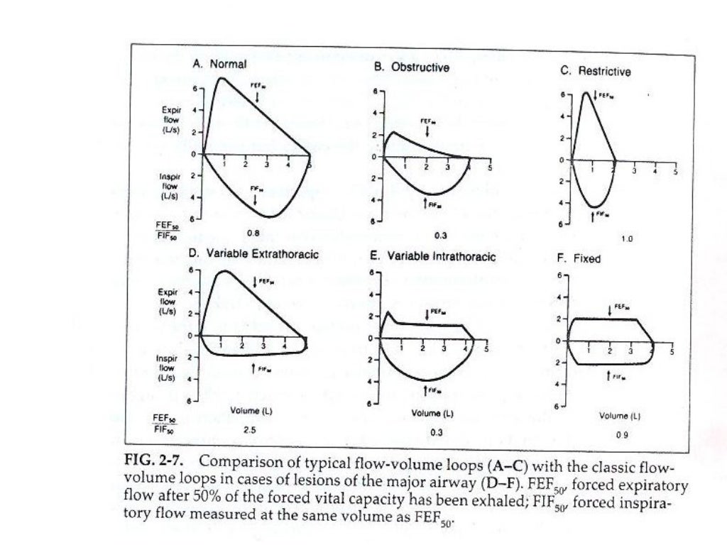 Spirometry Interpretation