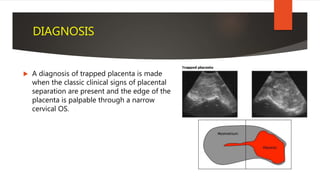 DIAGNOSIS
 A diagnosis of trapped placenta is made
when the classic clinical signs of placental
separation are present an...