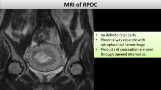 Retained products of conception dr.mohamed Soliman | PDF