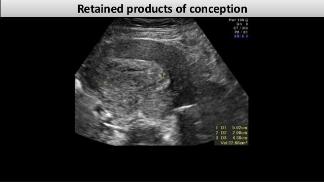 Retained products of conception dr.mohamed Soliman