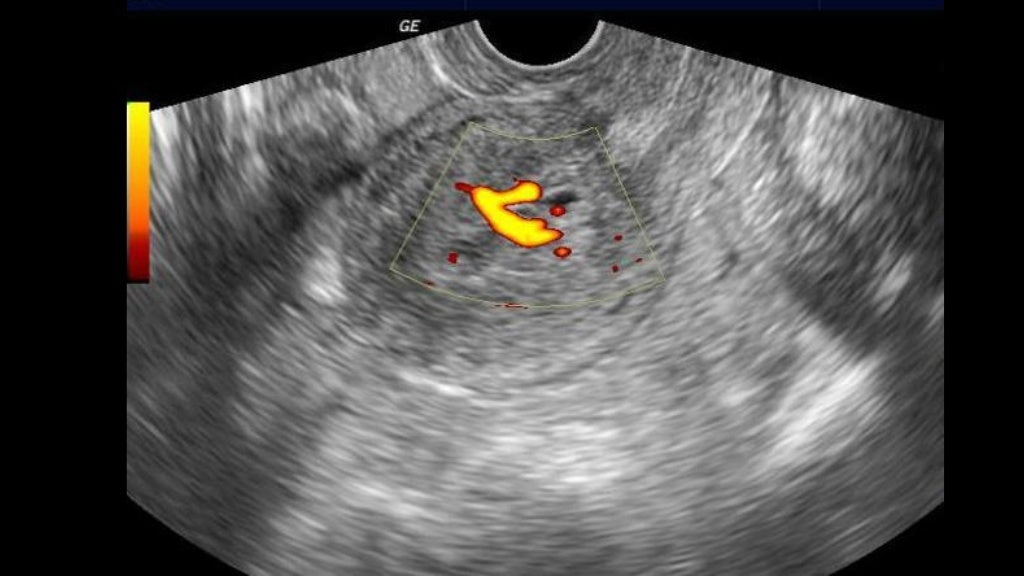 Retained products of conception dr.mohamed Soliman