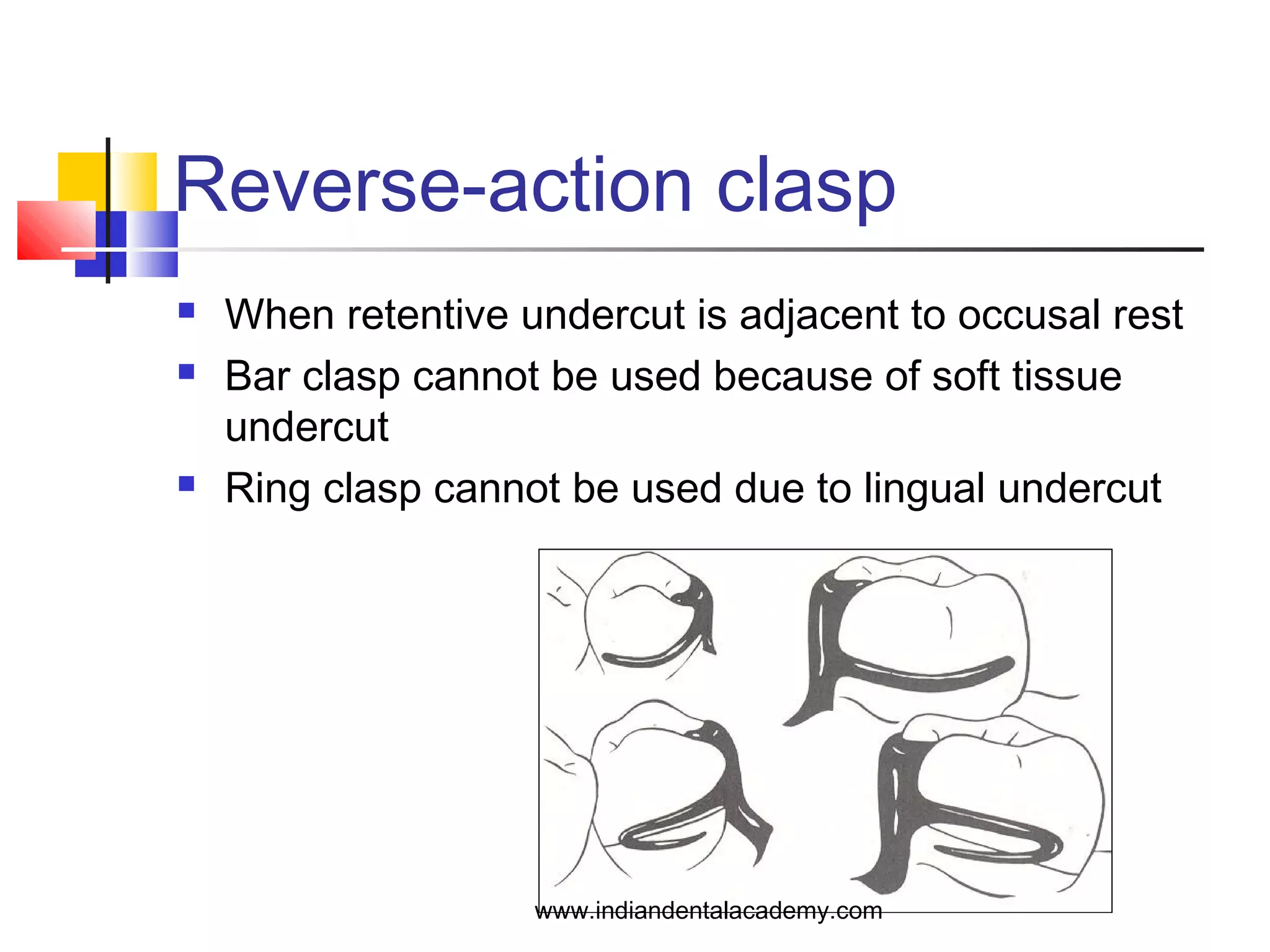 Reverse-action clasp
 When retentive undercut is adjacent to occusal rest
 Bar clasp cannot be used because of soft tissue
undercut
 Ring clasp cannot be used due to lingual undercut
www.indiandentalacademy.com
 