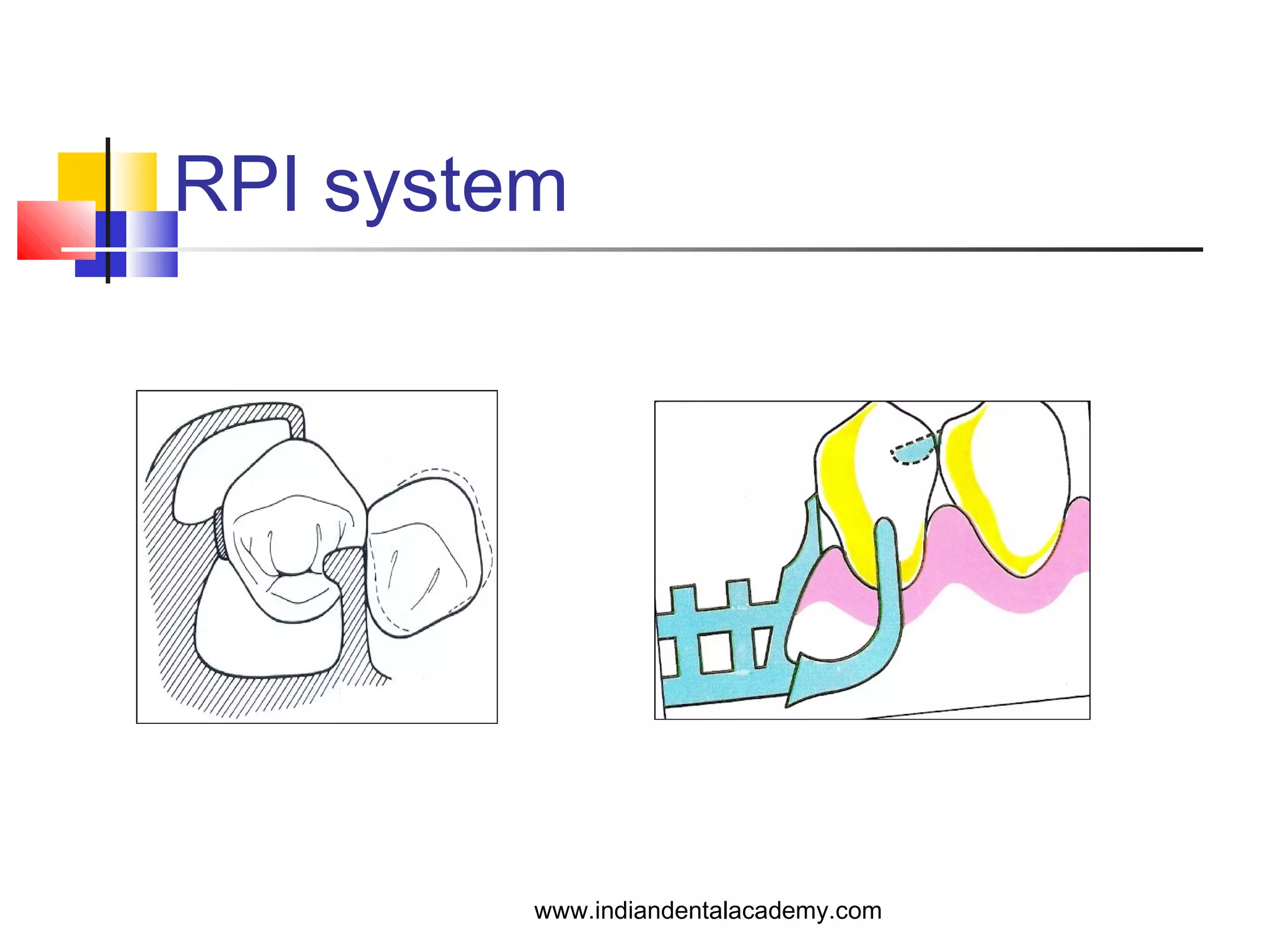 RPI system
www.indiandentalacademy.com
 
