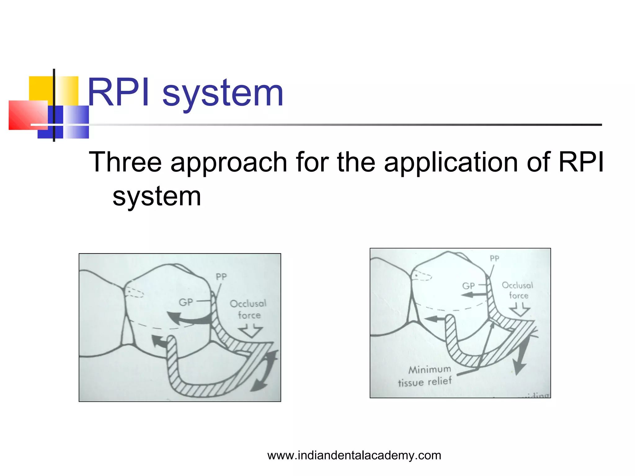 RPI system
Three approach for the application of RPI
system
www.indiandentalacademy.com
 