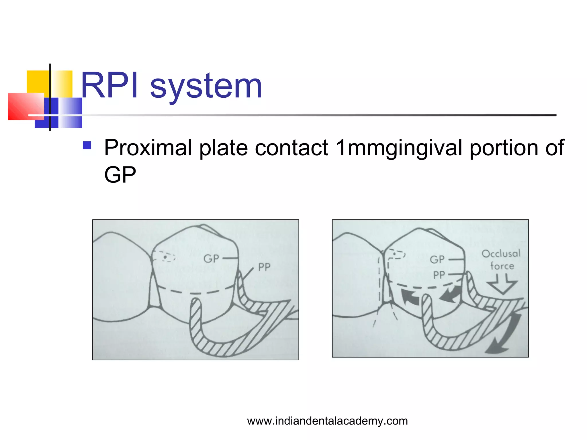RPI system
 Proximal plate contact 1mmgingival portion of
GP
www.indiandentalacademy.com
 