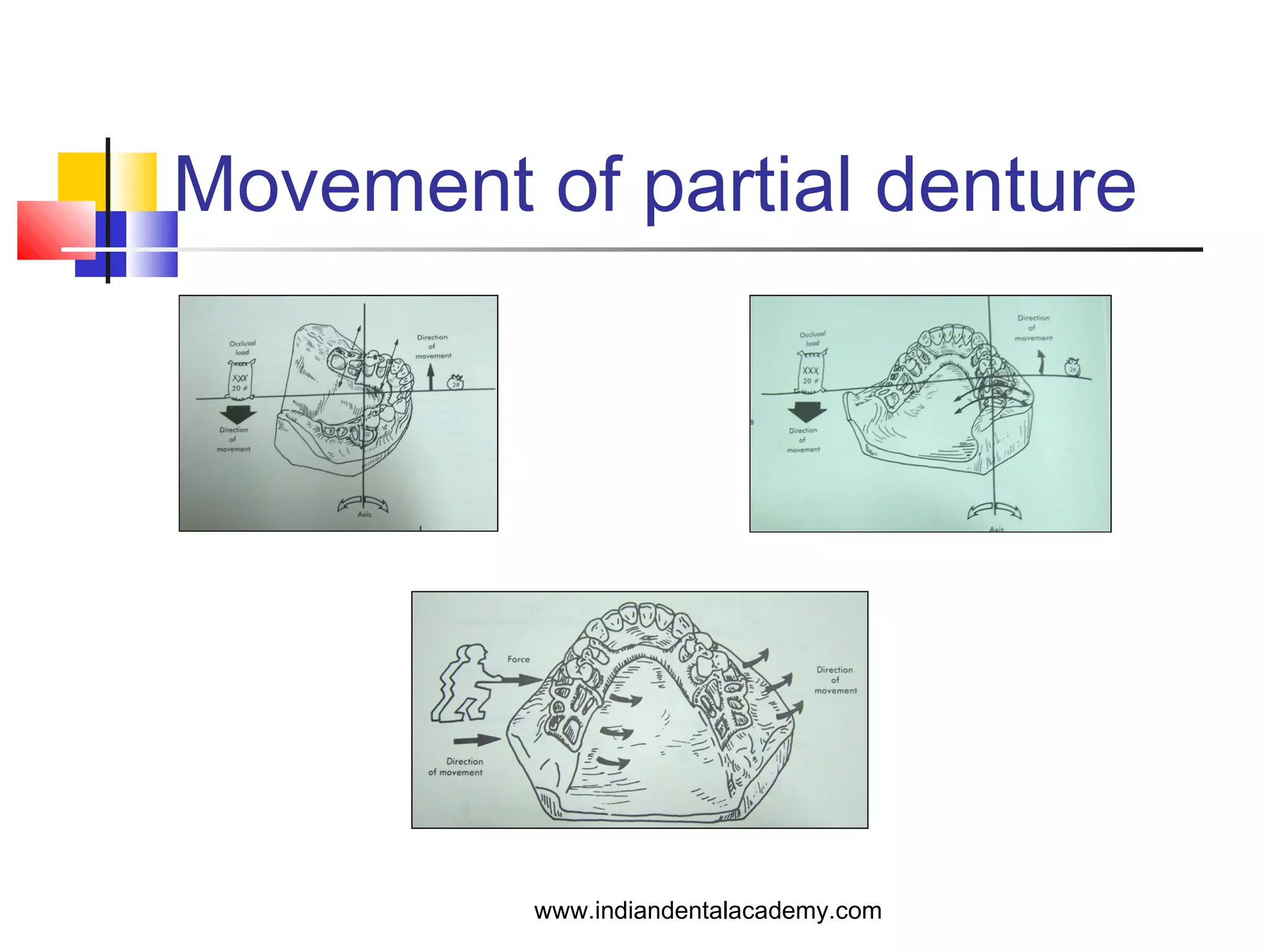 Movement of partial denture
www.indiandentalacademy.com
 