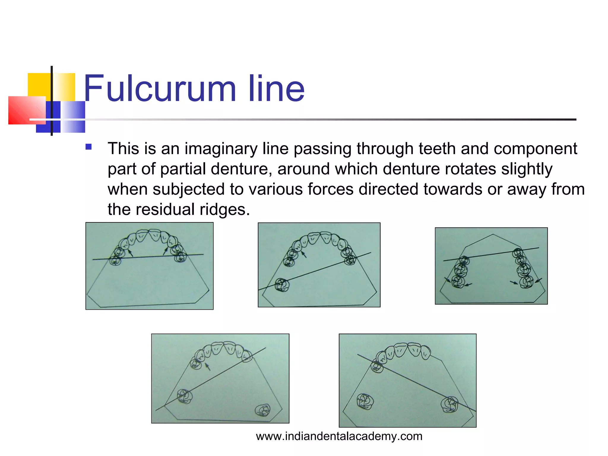 Fulcurum line
 This is an imaginary line passing through teeth and component
part of partial denture, around which denture rotates slightly
when subjected to various forces directed towards or away from
the residual ridges.
www.indiandentalacademy.com
 