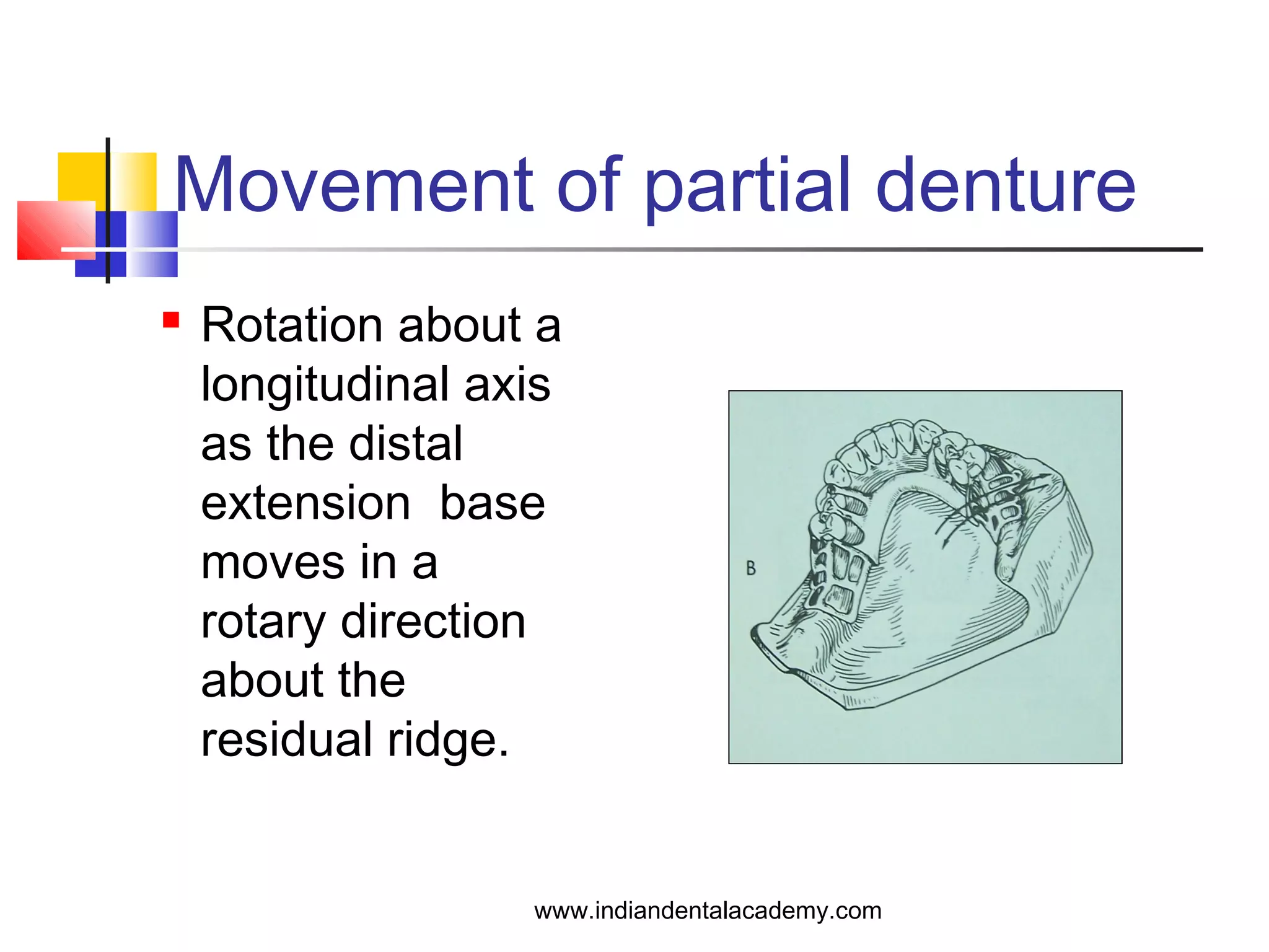 Movement of partial denture
 Rotation about a
longitudinal axis
as the distal
extension base
moves in a
rotary direction
about the
residual ridge.
www.indiandentalacademy.com
 