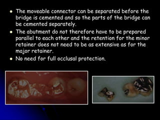 retainers for fixed partial denture dentistry . | PPT