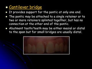 retainers for fixed partial denture dentistry . | PPT