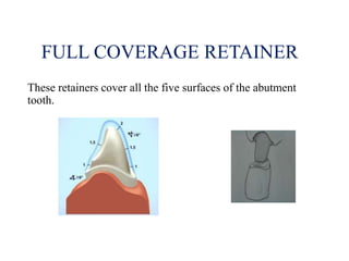 Retainers in fpd | PPT | Dental Health | Diseases and Conditions