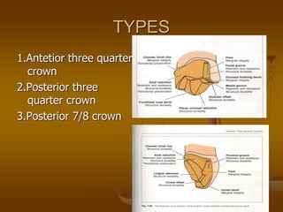 TYPES
1.Antetior three quarter
crown
2.Posterior three
quarter crown
3.Posterior 7/8 crown
 