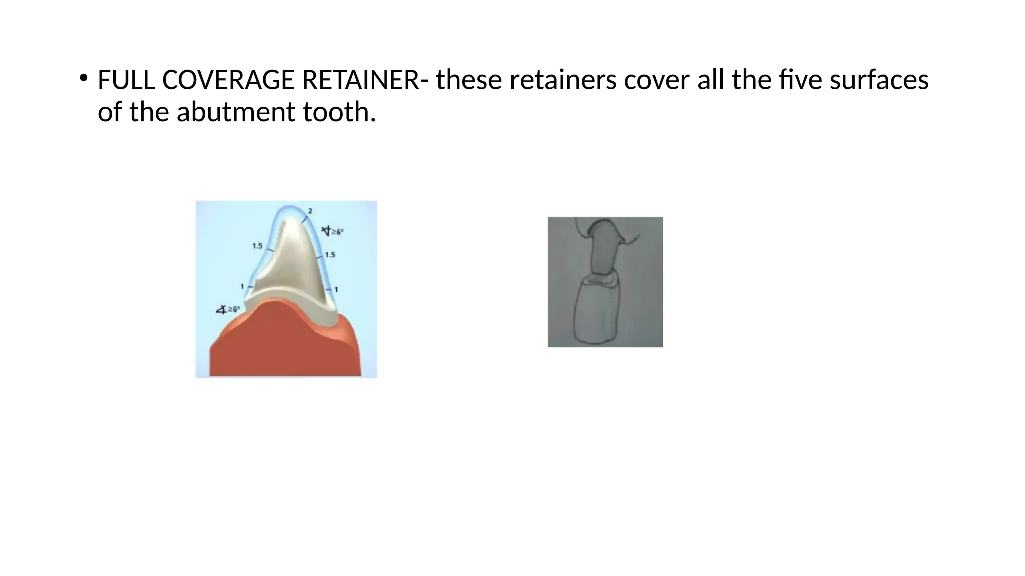 • FULL COVERAGE RETAINER- these retainers cover all the five surfaces
of the abutment tooth.
 