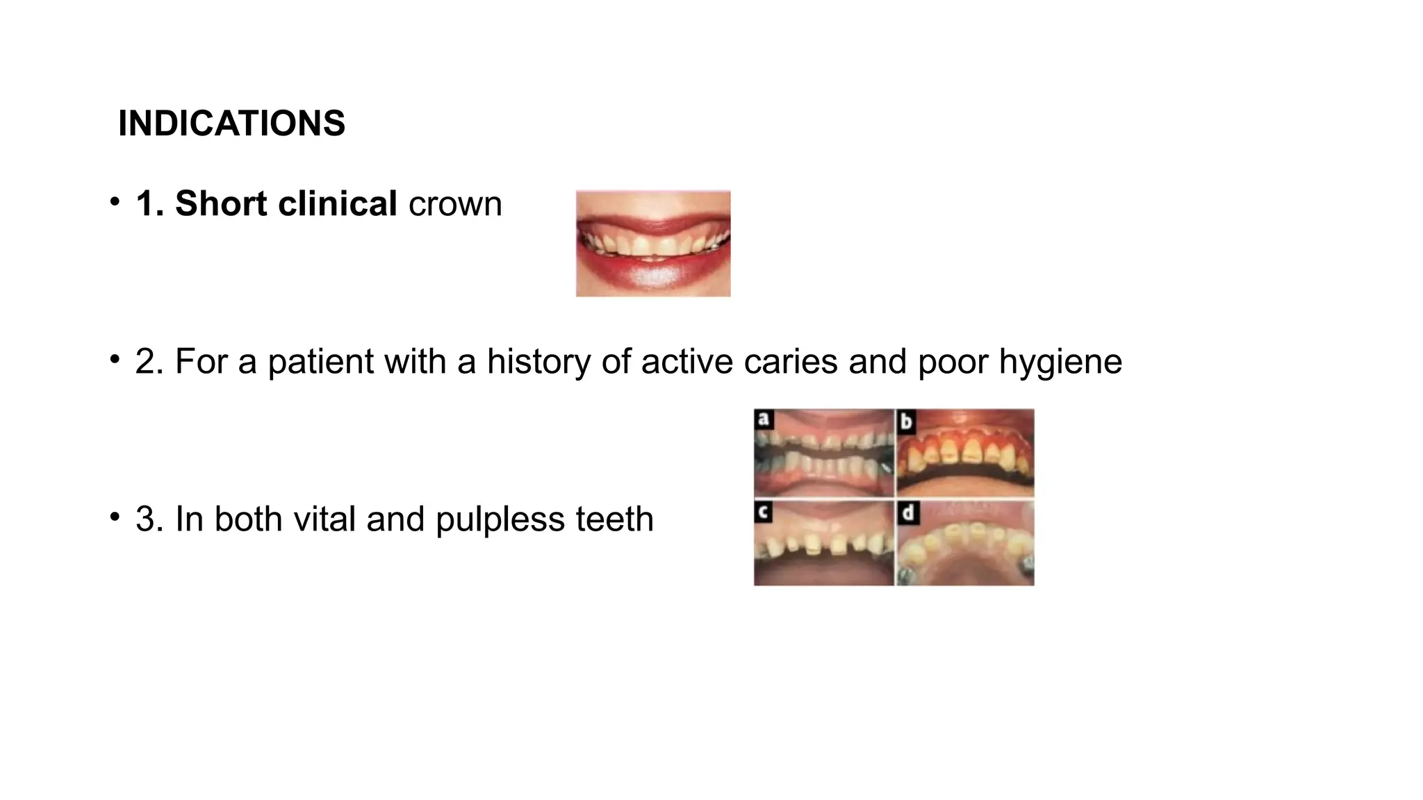 INDICATIONS
• 1. Short clinical crown
• 2. For a patient with a history of active caries and poor hygiene
• 3. In both vital and pulpless teeth
 