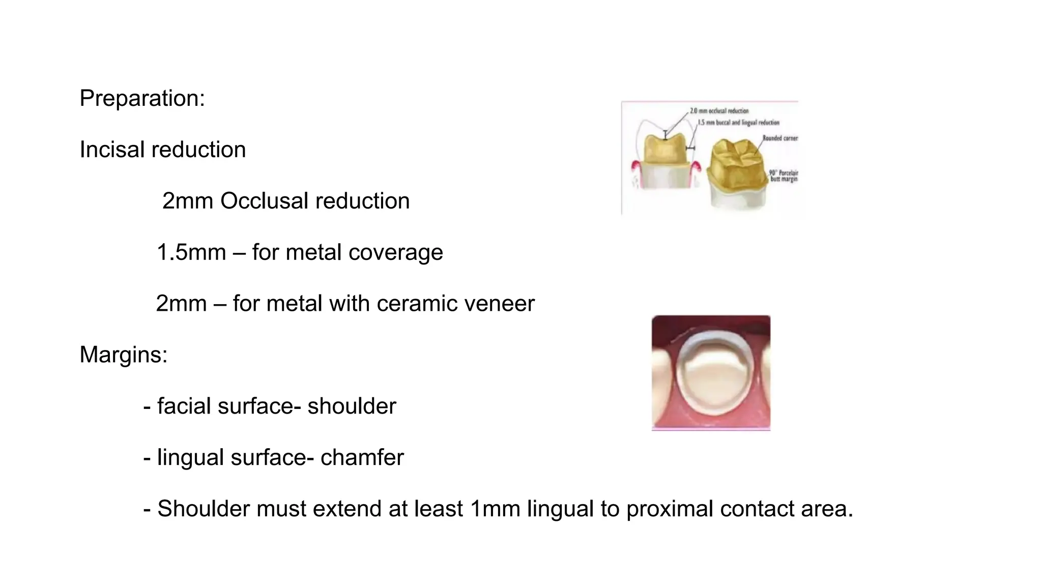 Preparation:
Incisal reduction
2mm Occlusal reduction
1.5mm – for metal coverage
2mm – for metal with ceramic veneer
Margins:
- facial surface- shoulder
- lingual surface- chamfer
- Shoulder must extend at least 1mm lingual to proximal contact area.
 