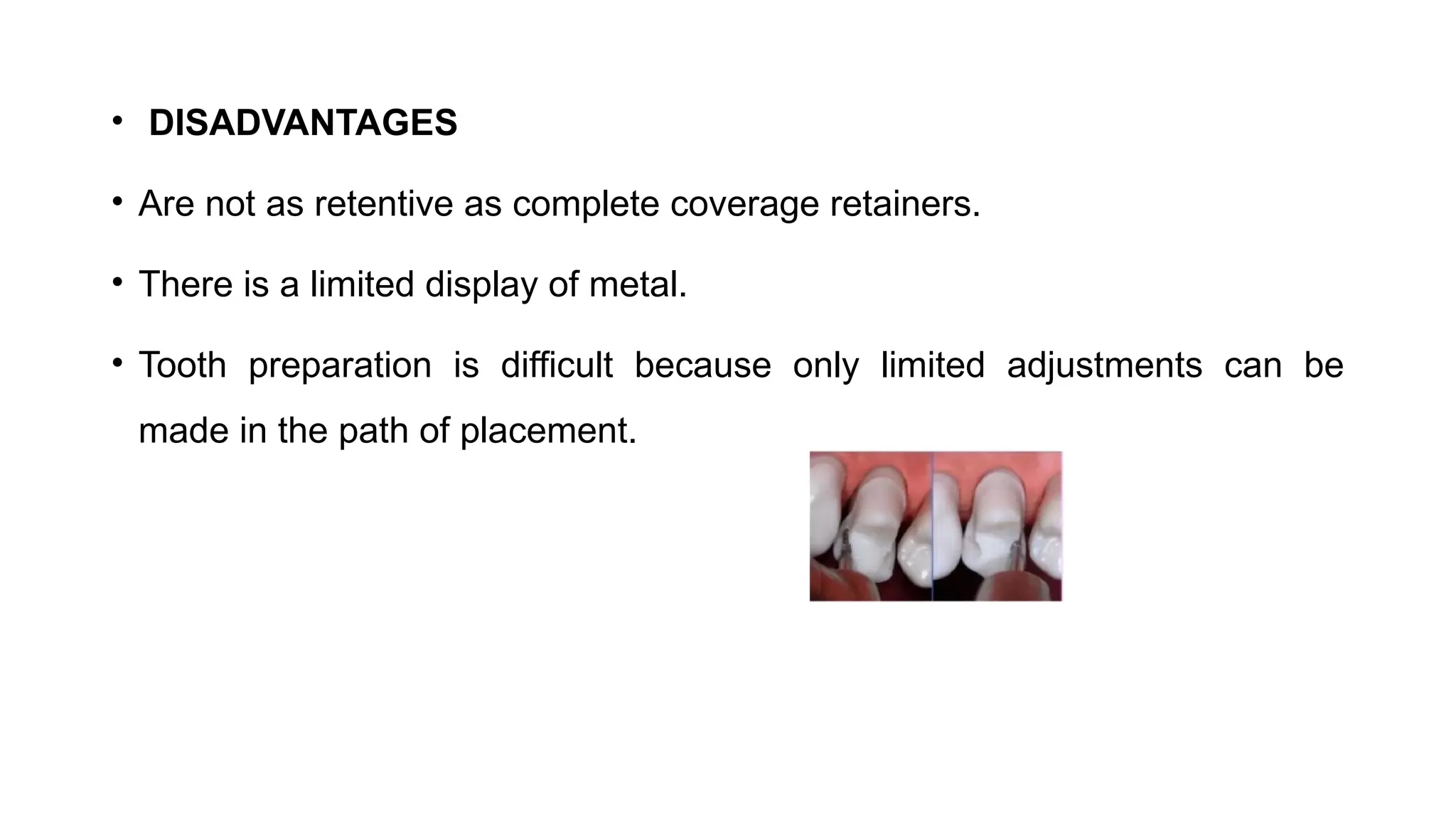 • DISADVANTAGES
• Are not as retentive as complete coverage retainers.
• There is a limited display of metal.
• Tooth preparation is difficult because only limited adjustments can be
made in the path of placement.
 