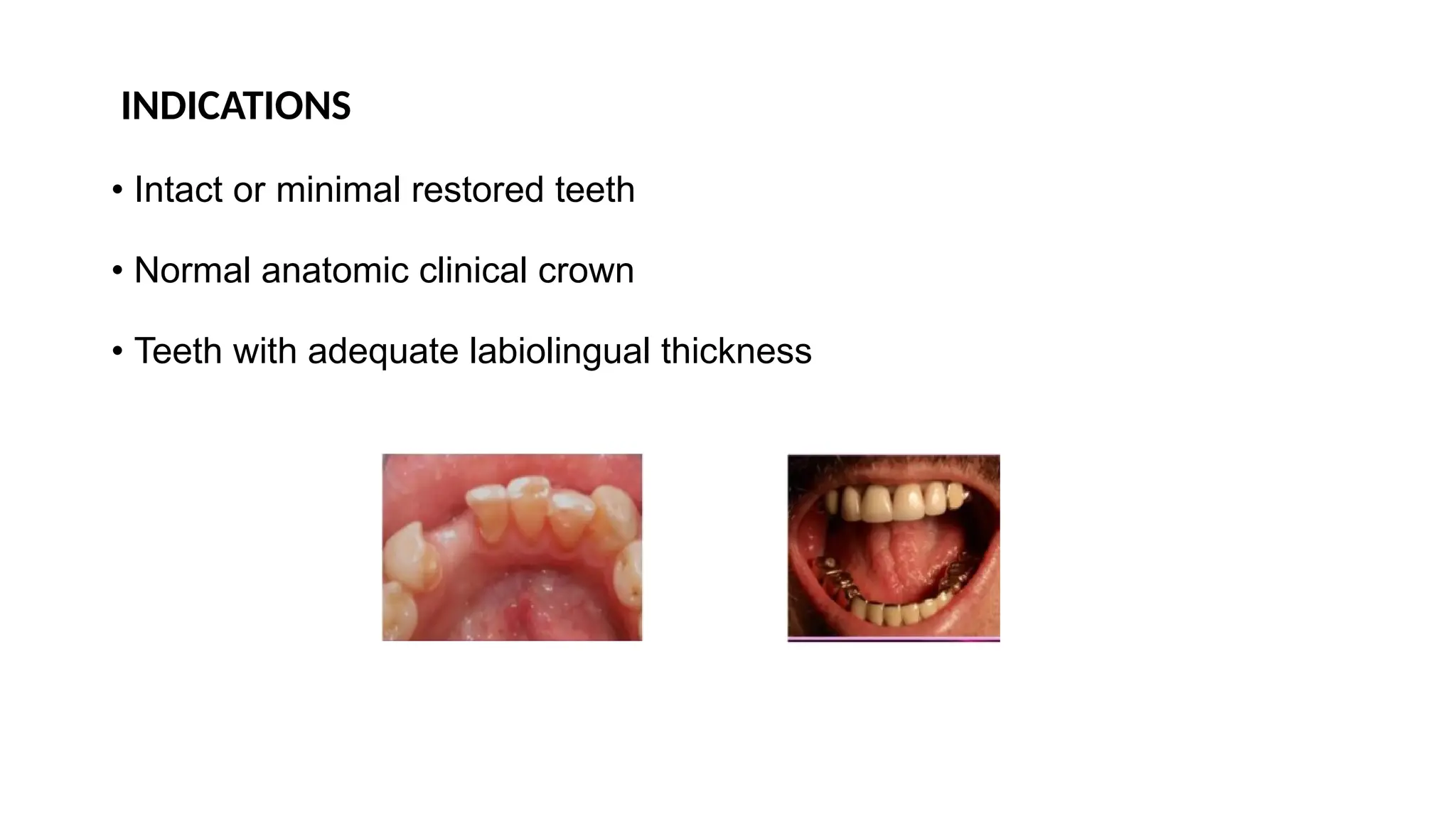 INDICATIONS
• Intact or minimal restored teeth
• Normal anatomic clinical crown
• Teeth with adequate labiolingual thickness
 