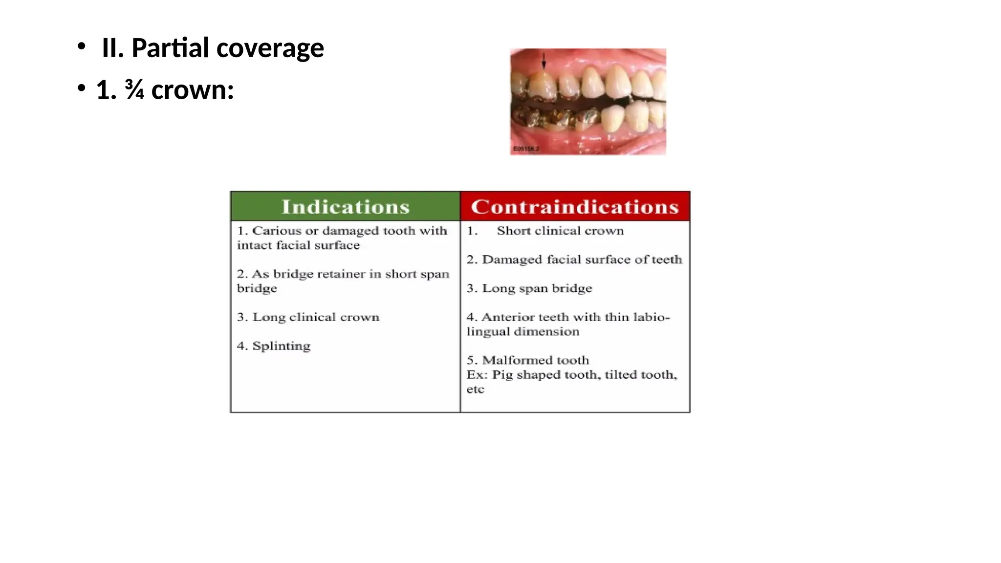 • II. Partial coverage
• 1. ¾ crown:
 