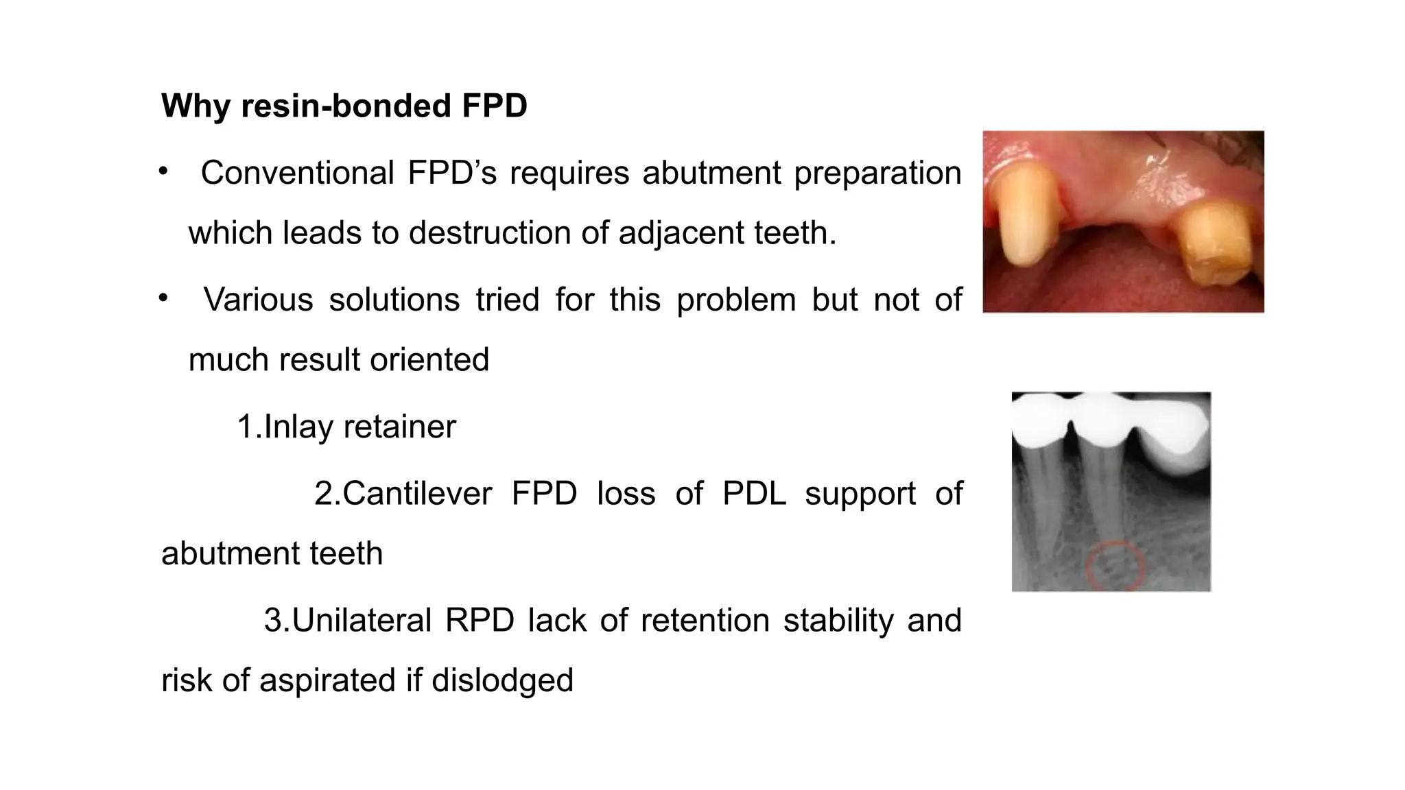 Why resin-bonded FPD
• Conventional FPD’s requires abutment preparation
which leads to destruction of adjacent teeth.
• Various solutions tried for this problem but not of
much result oriented
1.Inlay retainer
2.Cantilever FPD loss of PDL support of
abutment teeth
3.Unilateral RPD lack of retention stability and
risk of aspirated if dislodged
 