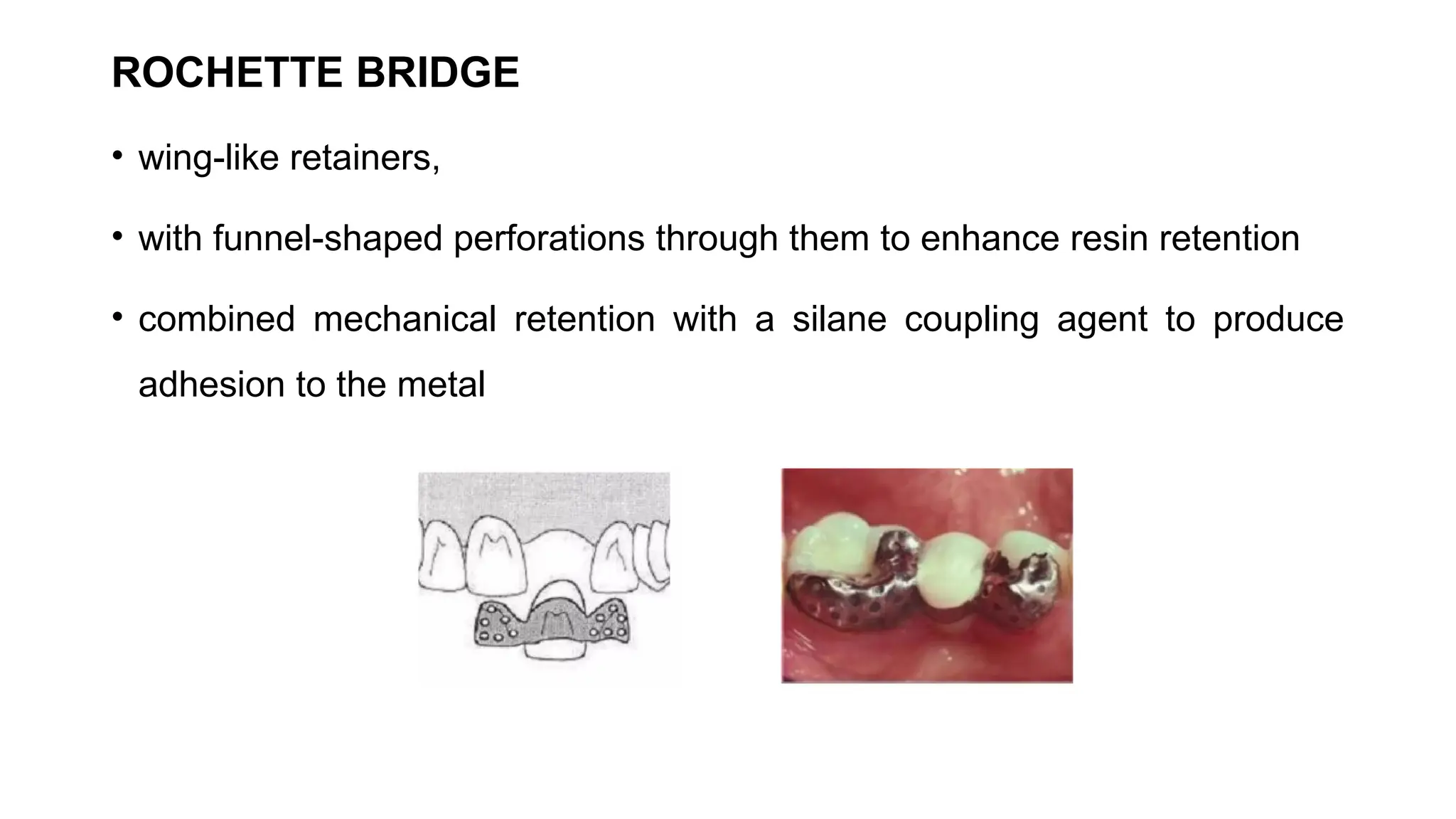 ROCHETTE BRIDGE
• wing-like retainers,
• with funnel-shaped perforations through them to enhance resin retention
• combined mechanical retention with a silane coupling agent to produce
adhesion to the metal
 
