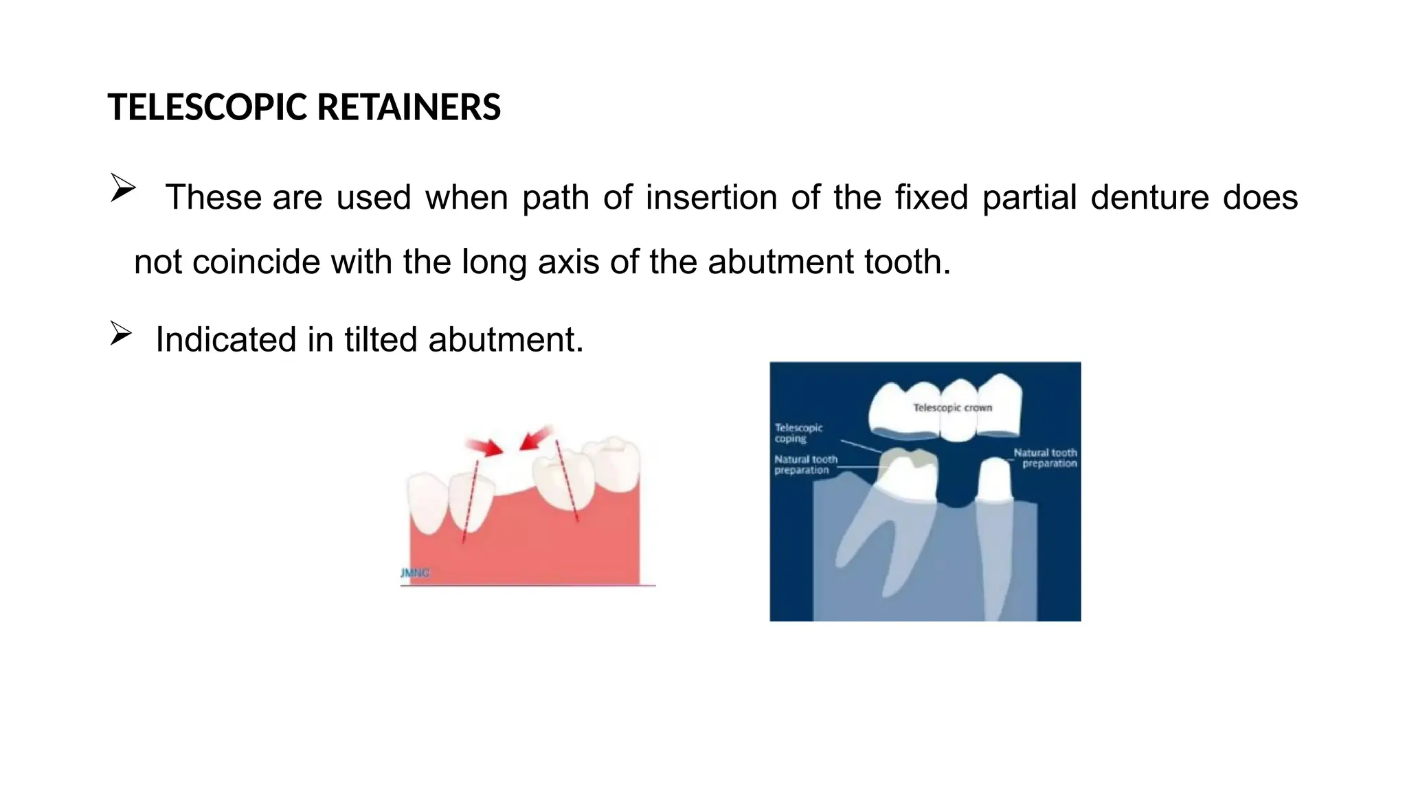 TELESCOPIC RETAINERS
 These are used when path of insertion of the fixed partial denture does
not coincide with the long axis of the abutment tooth.
 Indicated in tilted abutment.
 