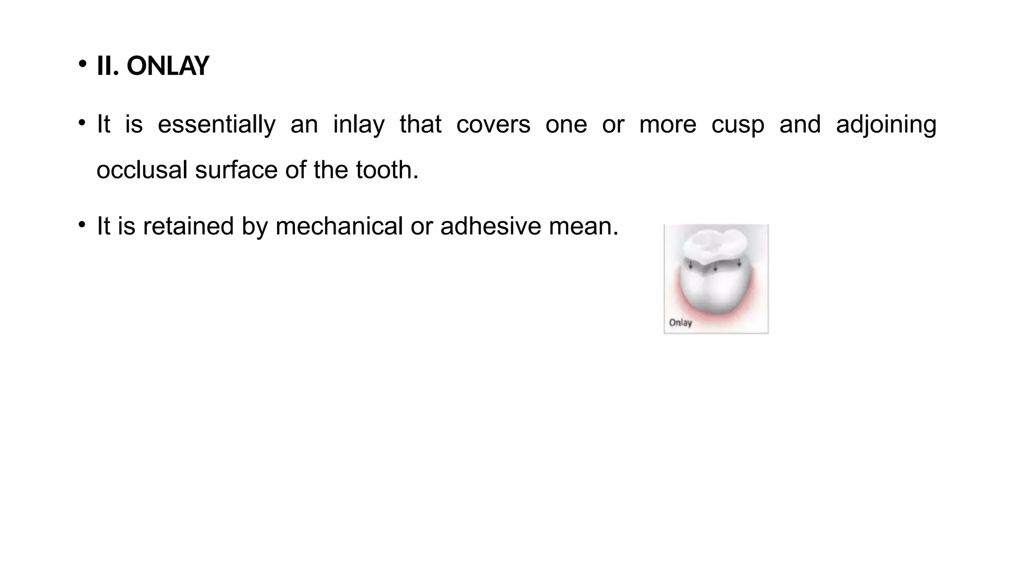 • II. ONLAY
• It is essentially an inlay that covers one or more cusp and adjoining
occlusal surface of the tooth.
• It is retained by mechanical or adhesive mean.
 