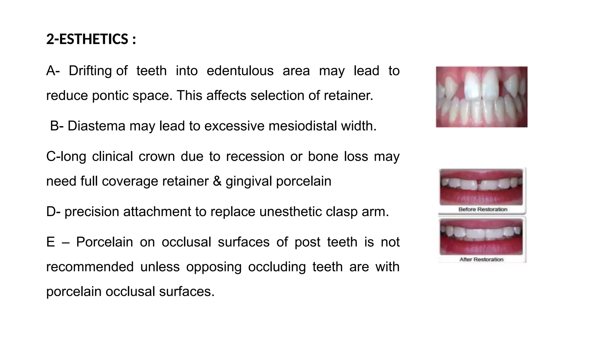 2-ESTHETICS :
A- Drifting of teeth into edentulous area may lead to
reduce pontic space. This affects selection of retainer.
B- Diastema may lead to excessive mesiodistal width.
C-long clinical crown due to recession or bone loss may
need full coverage retainer & gingival porcelain
D- precision attachment to replace unesthetic clasp arm.
E – Porcelain on occlusal surfaces of post teeth is not
recommended unless opposing occluding teeth are with
porcelain occlusal surfaces.
 