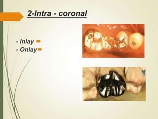 2-Intra - coronal

- Inlay

- Onlay
 
